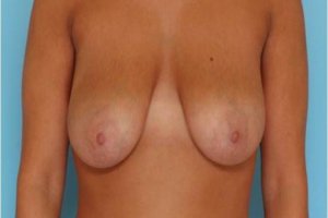 Manhattan Breast Lift before 7